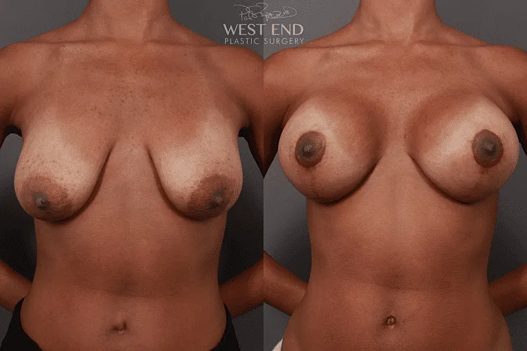 Before & After Image of Breast Lift Washington DC
