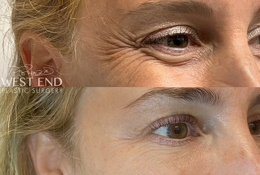 Fat Transfer Surgery Washington DC