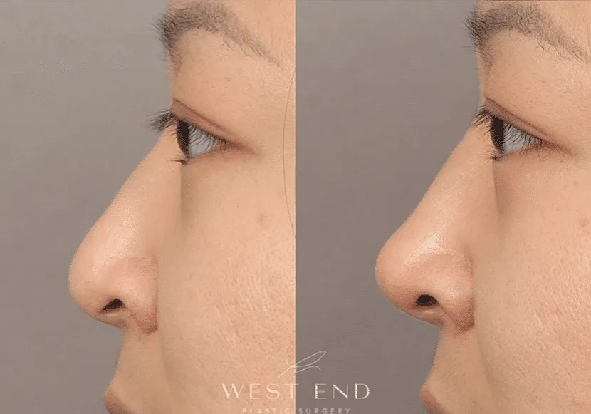 Before and After Image of Liquid Rhinoplasty Washington D.C.