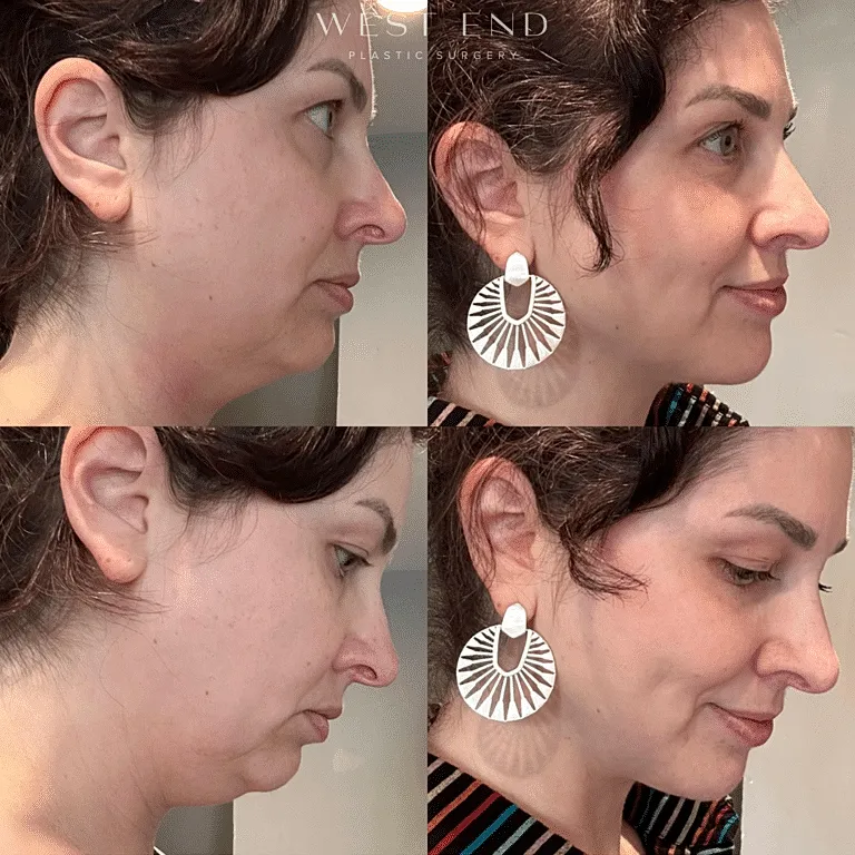 Chin & Neck Liposuction Expert Washington DC