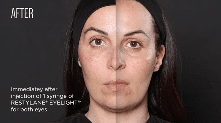 Before and After Image of Restylane® Eyelight ™ Washington DC