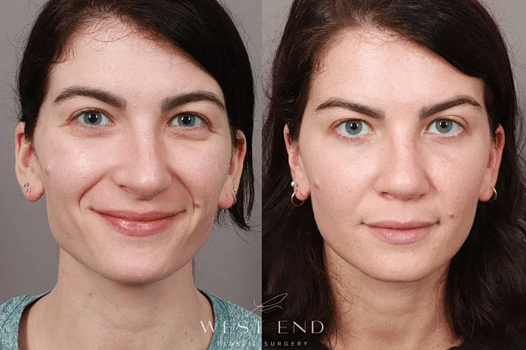 before & after image