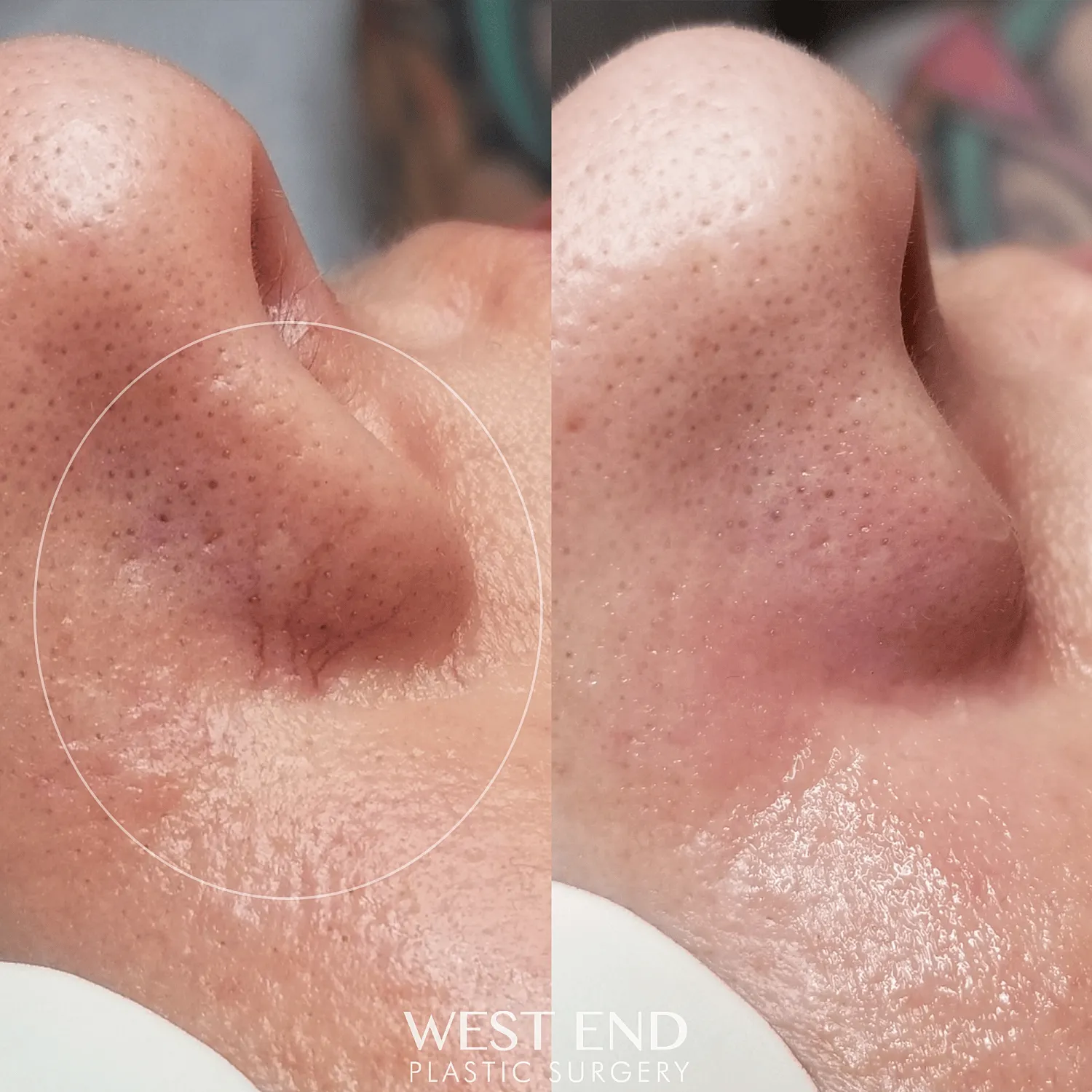 Before and After Image of IPL Skin Treatment Washington DC