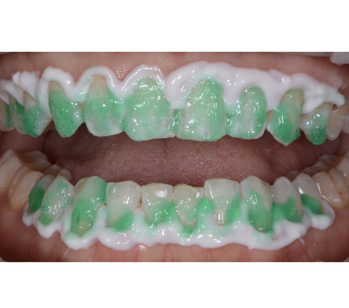 Icon White Spot Treatment